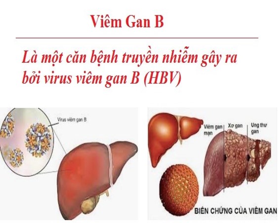 Bệnh viêm gan do vi rút